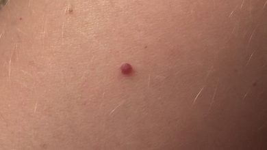 angioma