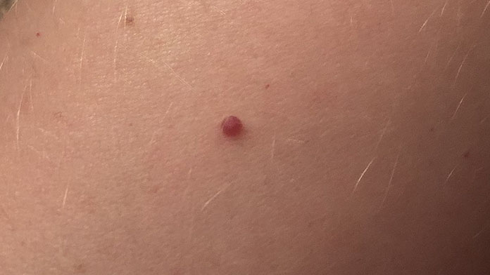 angioma