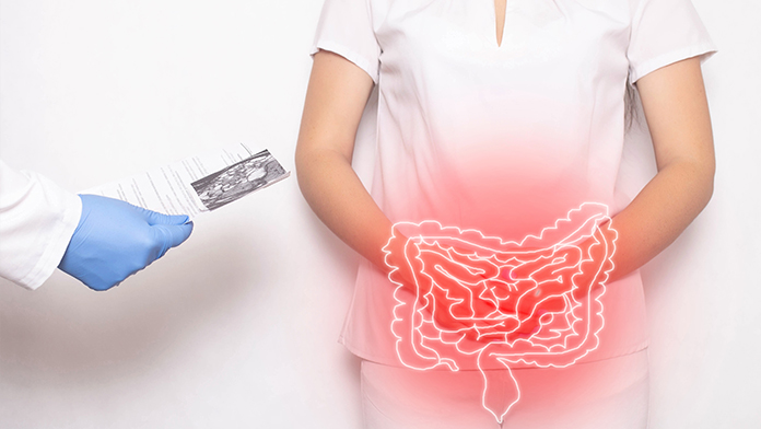 intestino infiammato con fistole anali malattia di crohn