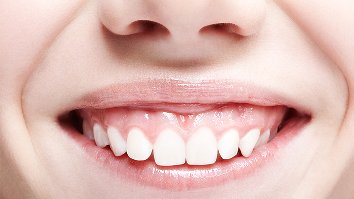 donna che sorride con gengive marcate sopra ai denti con sorriso gengivale