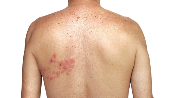 herpes zoster vaccinazione pazienti oncologici