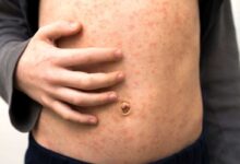 persona con chiazze di morbillo sulla pancia