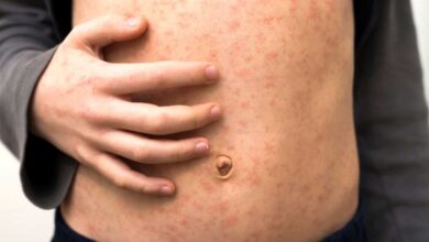 persona con chiazze di morbillo sulla pancia