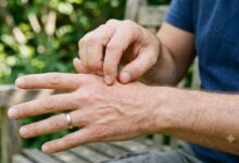 uomo che si gratta la mano perché ha la scabbia