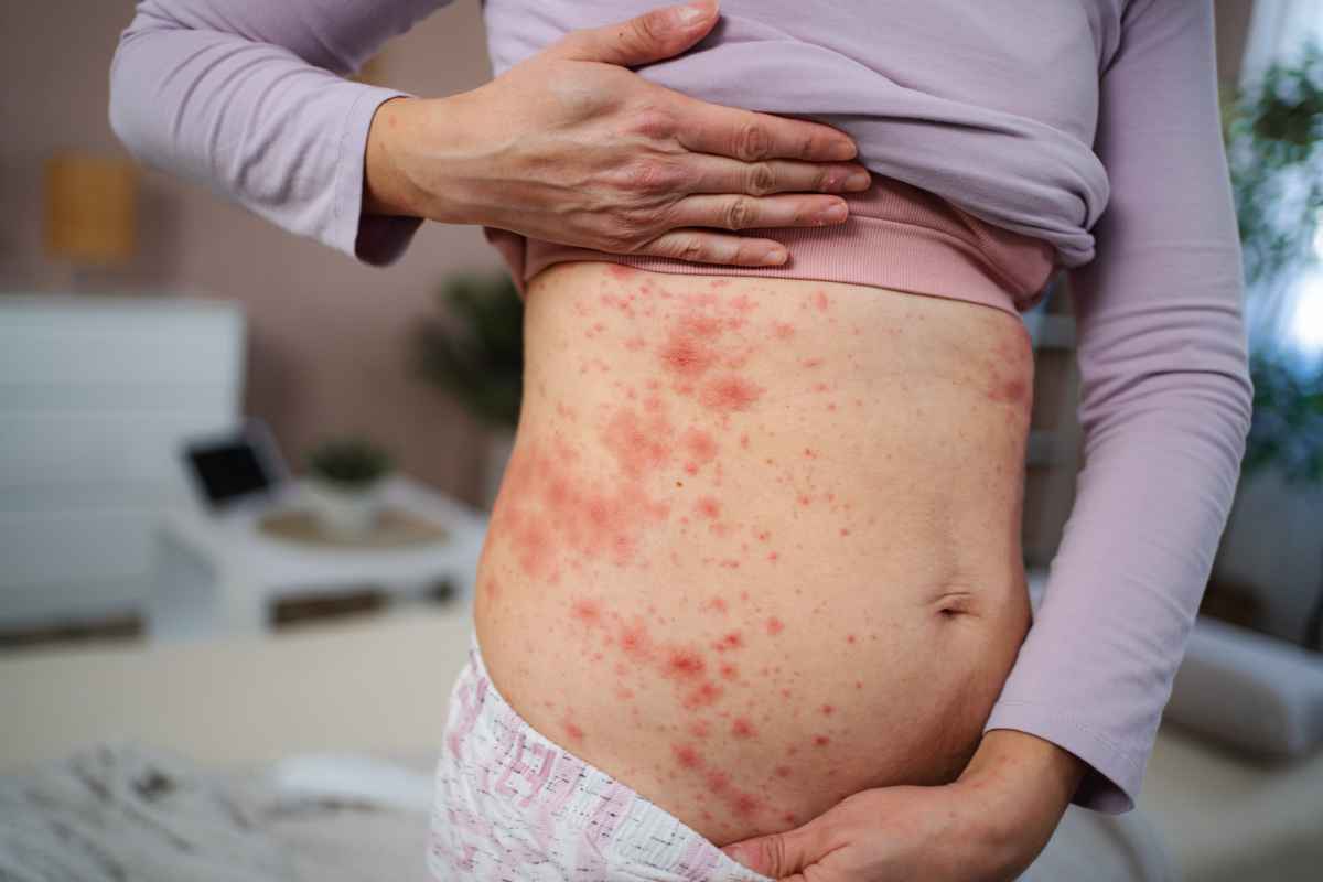 bambina con i segni della quinta malattia sull'addome