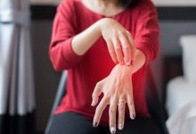 acqua di carta contro le dermatiti