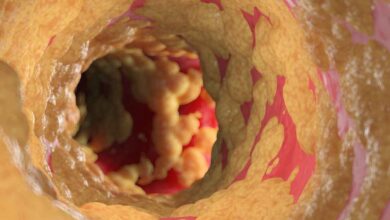 3d ha reso l'illustrazione di un'arteria umana grassa
