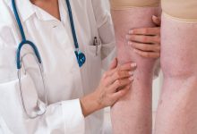 avere vene varicose aumenta il rischio di infarto