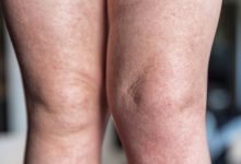 edema alla gambe