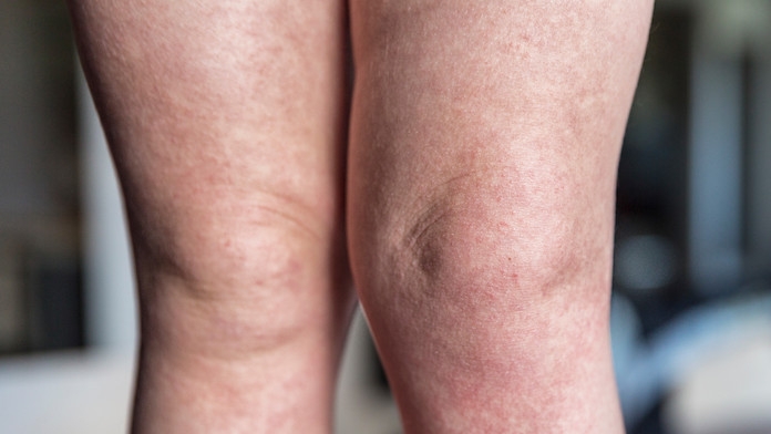 edema alla gambe