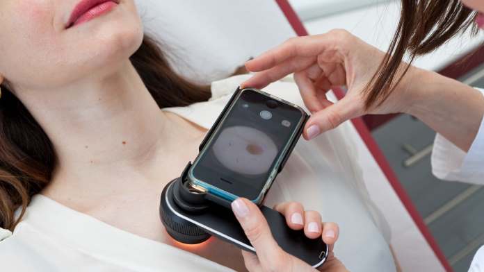 trattamenti per il melanoma