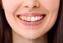 igiene orale e tumore al pancreas