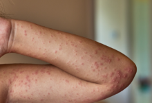 mastocitosi sistemica indolente