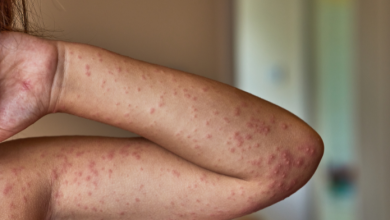 mastocitosi sistemica indolente