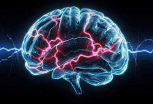 nuova terapia per la malattia di Huntington