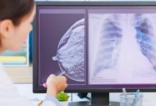 un medico visiona gli esami diagnostici di una paziente con tumore al seno