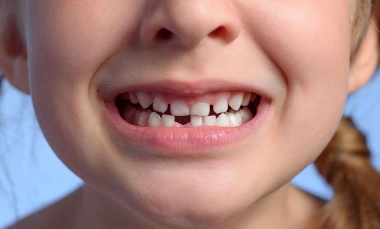 bambina in primo piano con bocca aperta e un dente sotto mancante