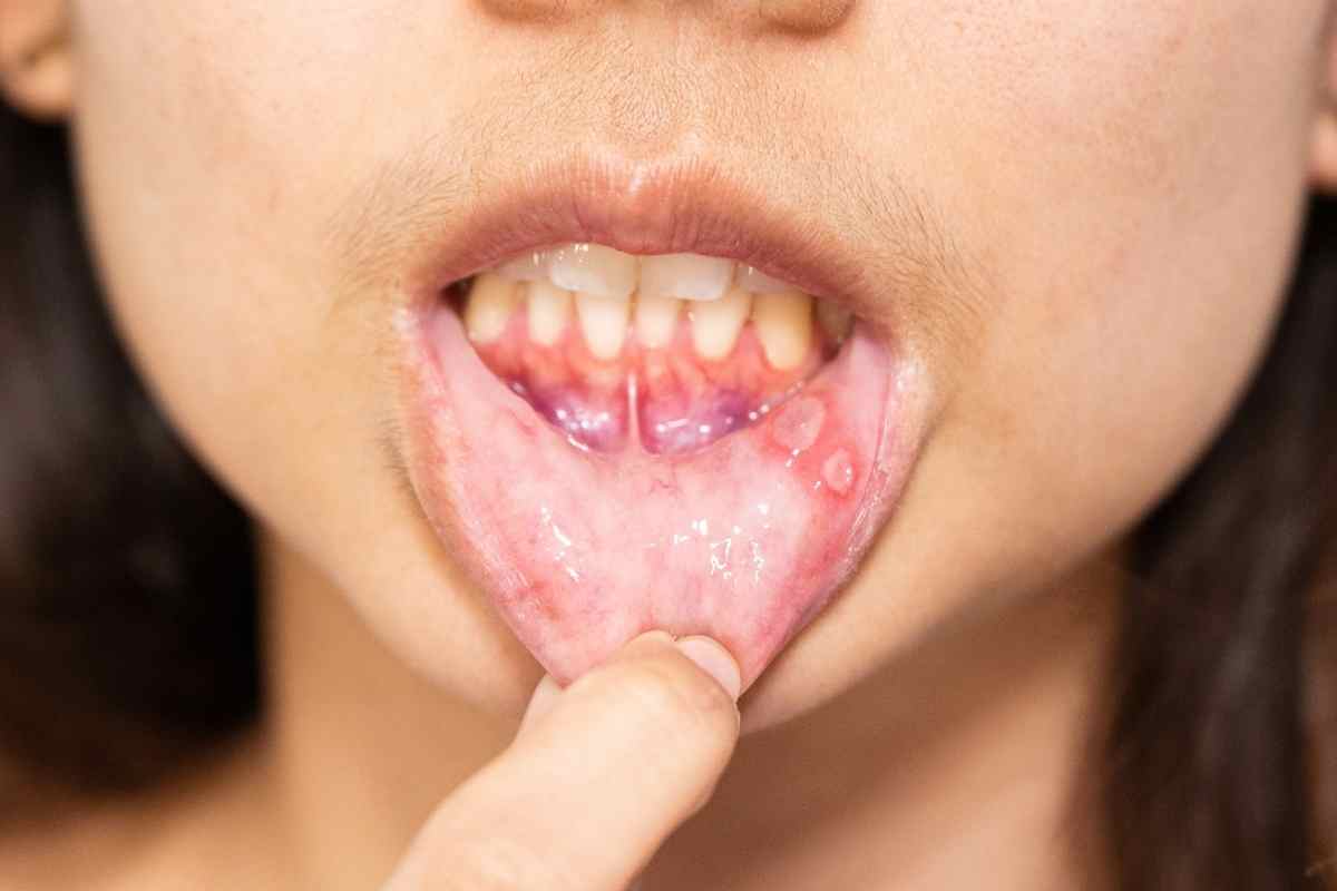 una ragazza mostra delle lesioni all'interno del cavo orale 