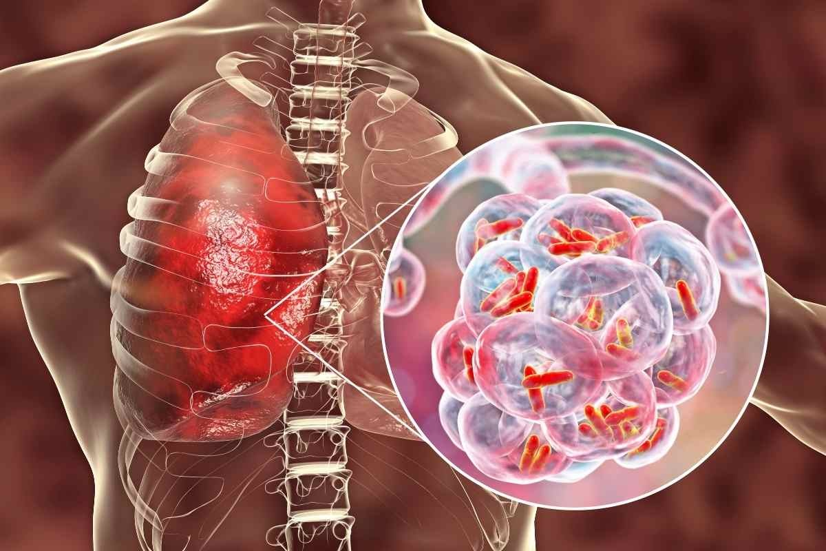 immagine che raffigura il polmone colpito d virus