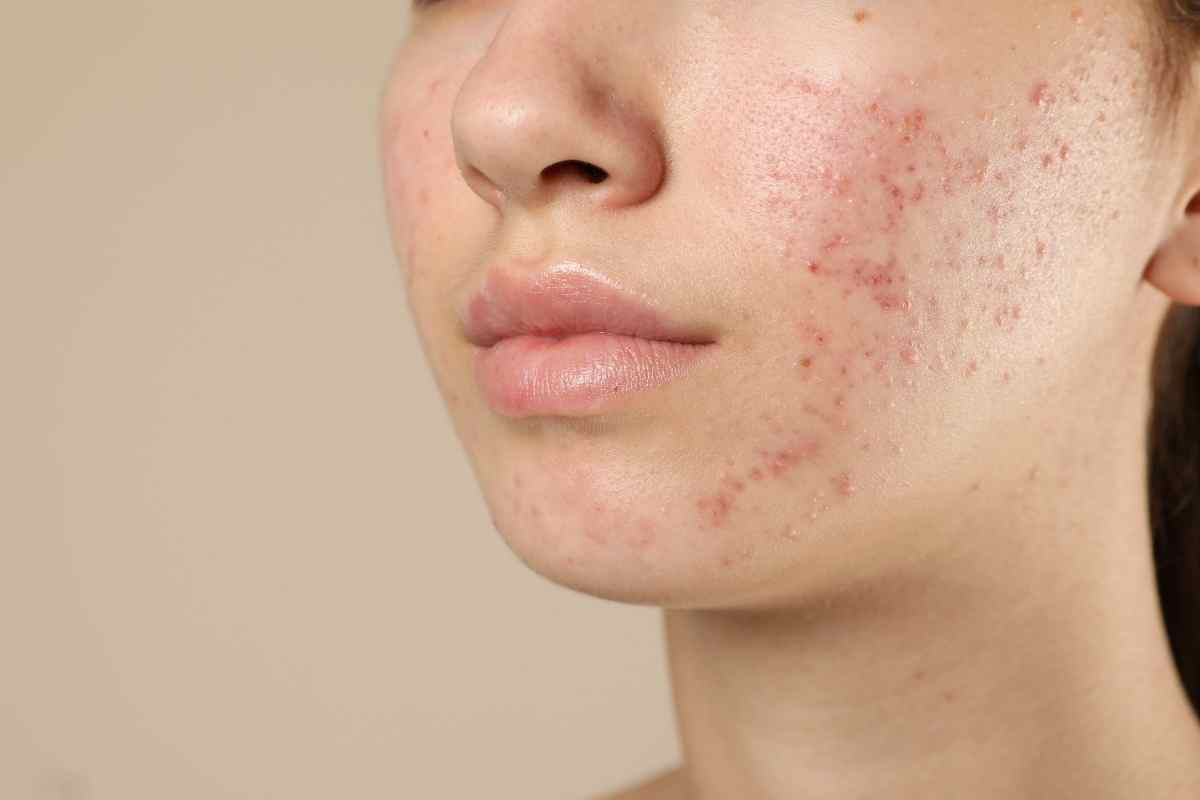 una ragazza con acne