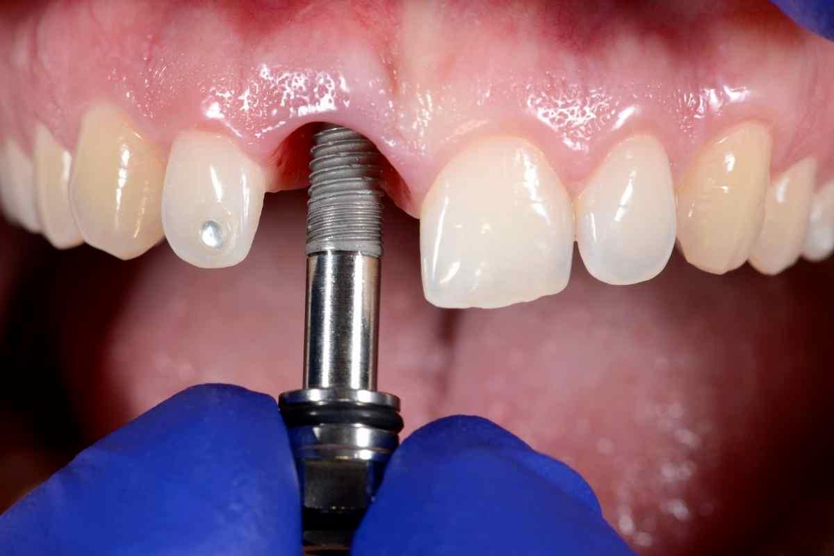 un dentista esegue l'impianto dentale a un paziente 