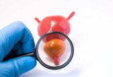un medico usa la lente di ingrandimento su un modellino che raffigura una vescica