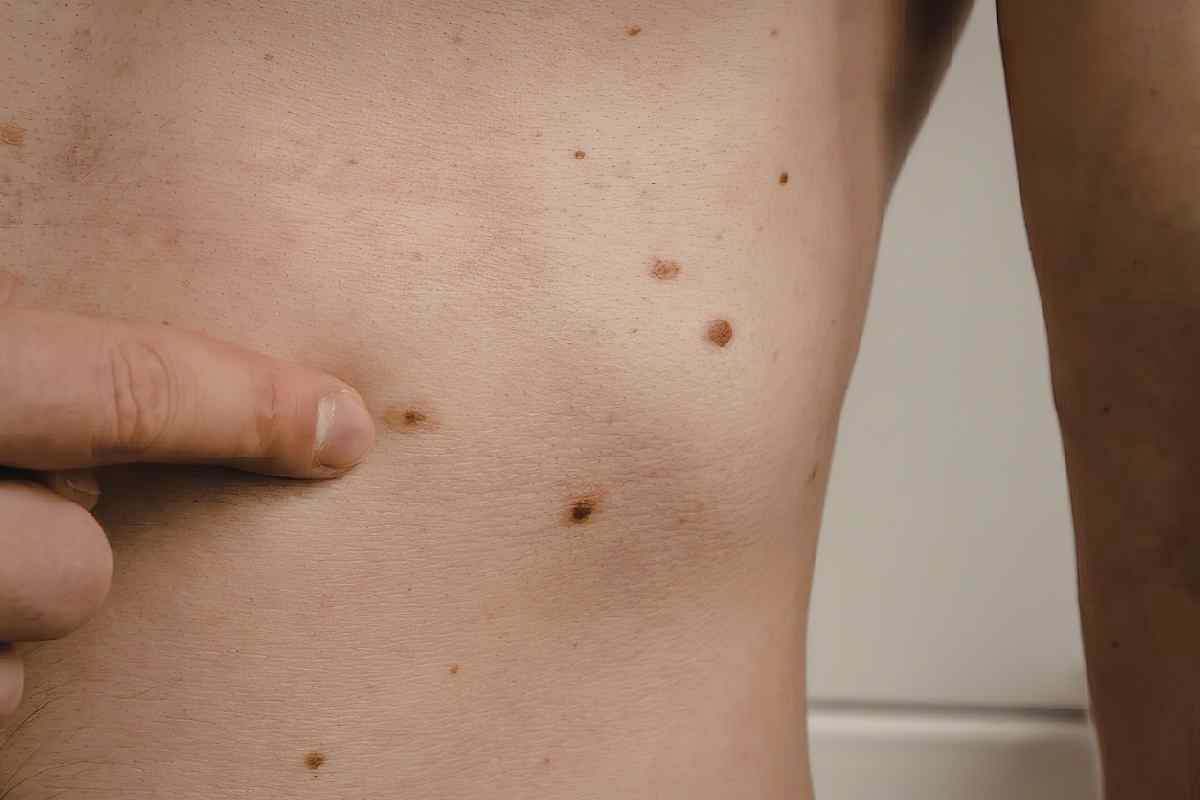 un medico controlla la schiena piena di nei di una paziente 