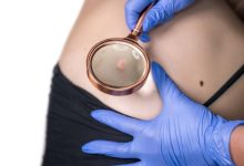 paziente che si sottopone a visita dermatologica per riconoscere un melanoma