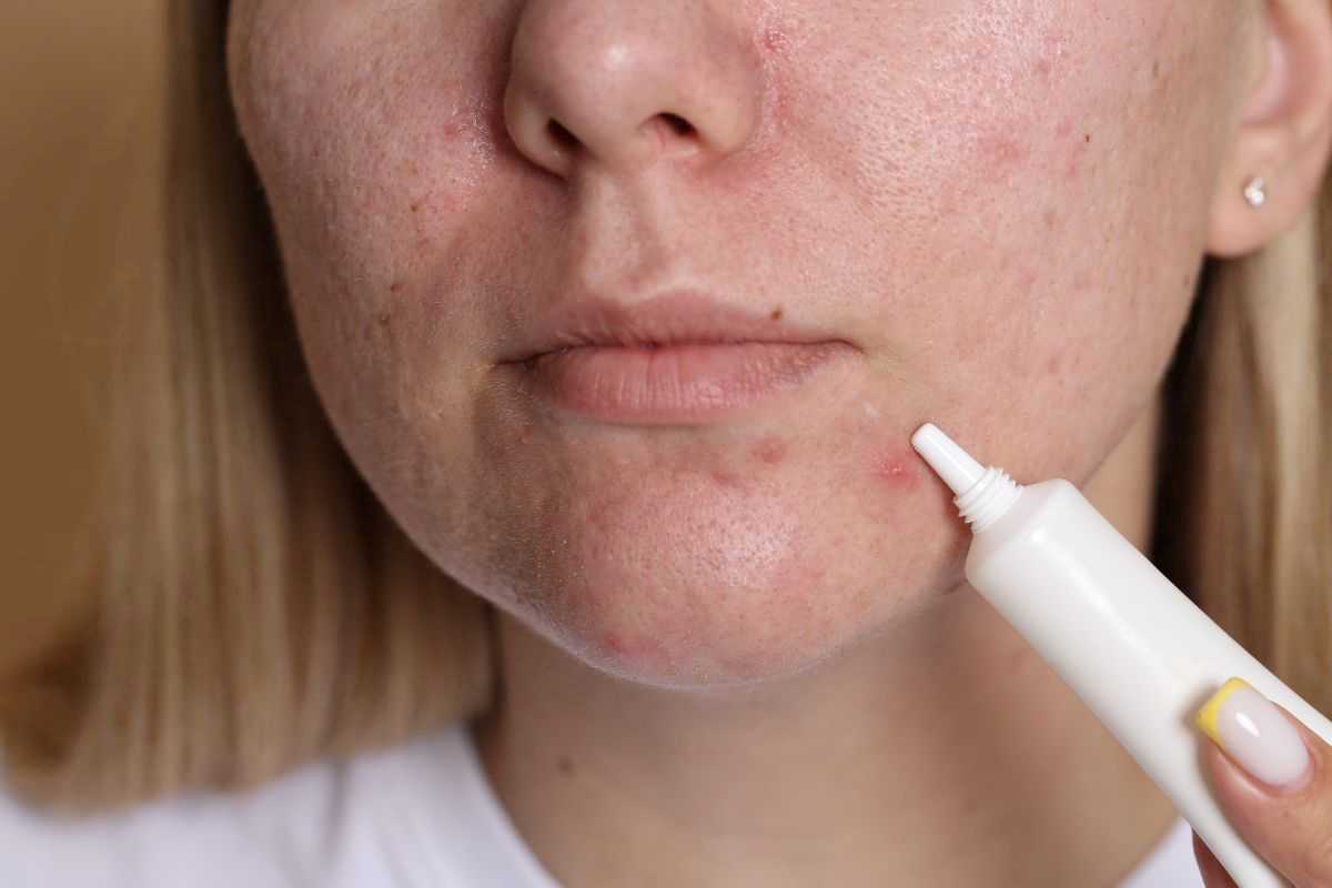 donna con pelle del viso con acne