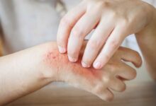 donna che si gratta una mano che gli crea prurito