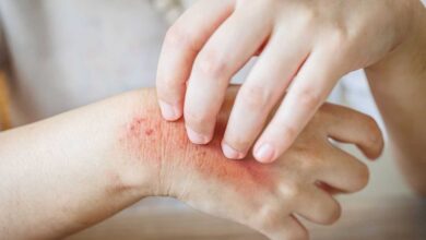 donna che si gratta una mano che gli crea prurito