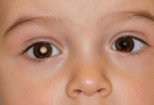 bambino che presenta pupilla bianca, sintomo di retinoblastoma
