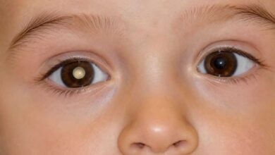 bambino che presenta pupilla bianca, sintomo di retinoblastoma