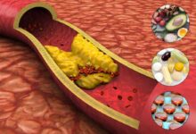 immagine di arteria con colesterolo borderline con affianco immagini di dieta sana, integratori, statine