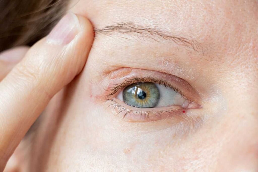 Una palpebra che si abbassa improvvisamente? Può essere una patologia neuromuscolare
