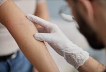 un dermatologo controlla i nei sul braccio di una paziente