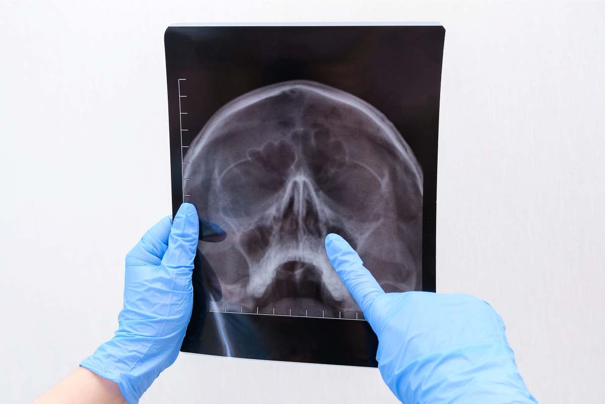 un medico indica un edema cerebrale su una lastra 