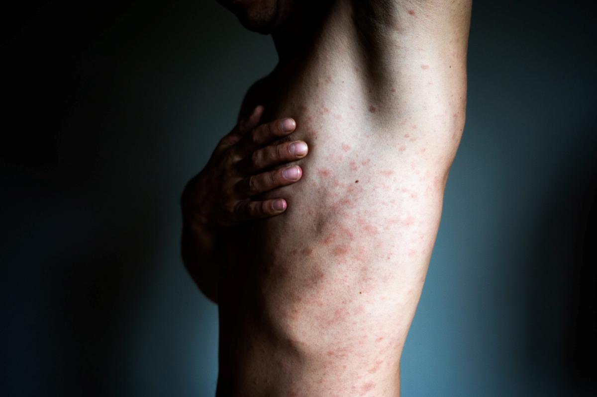 Malattia Della Pioggia o Dermatofilosi La Patologia Degli Animali Malattia Della Pioggia o Dermatofilosi La Patologia Degli Animali
