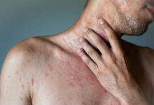 un uomo con molte eruzioni cutanee su collo e torace