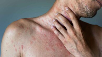 un uomo con molte eruzioni cutanee su collo e torace