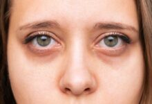 faccia stanca con occhiaie di donna che ha la ferritin face