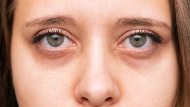 faccia stanca con occhiaie di donna che ha la ferritin face