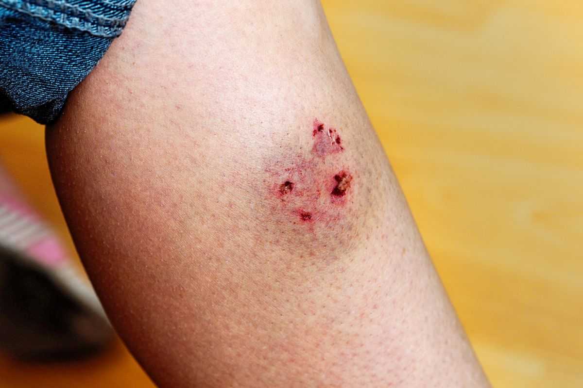 gamba di una persona con i segni di un morso di cane