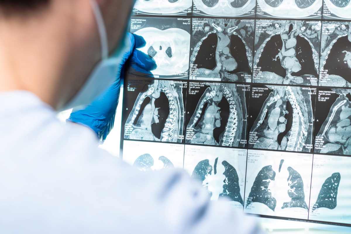 un medico analizza gli esiti di una TAC polmone