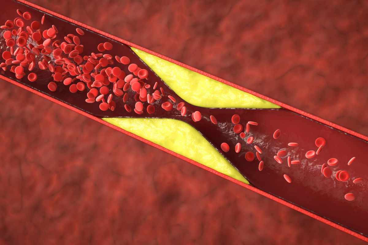 disegno che mostra l'accumulo di colesterolo nelle arterie