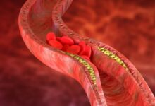 disegno che mostra l'accumulo di colesterolo nelle arterie