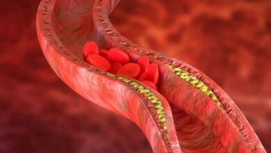 disegno che mostra l'accumulo di colesterolo nelle arterie