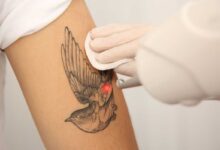 rimozione tatuaggi con laser