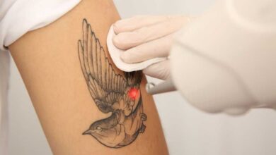 rimozione tatuaggi con laser