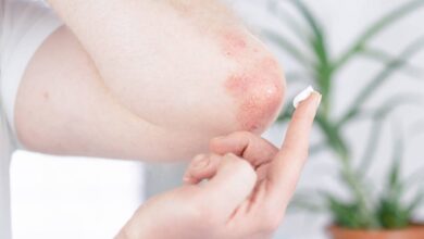 un uomo con psoriasi si spalma della crema sul gomito